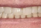 Teeth Whitening Perth Treatment Explained for Beginners