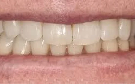 Teeth Whitening Perth Treatment Explained for Beginners