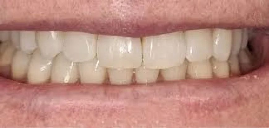 Teeth Whitening Perth Treatment Explained for Beginners