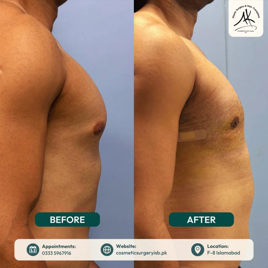 When Is the Right Time to Consider Gynecomastia Surgery Near Me