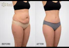 Tummy Tuck in Islamabad: Your Guide to a Confident New You