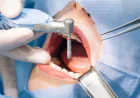 Is the Dental Implant Procedure Painful? What to Really Expect Step by Step
