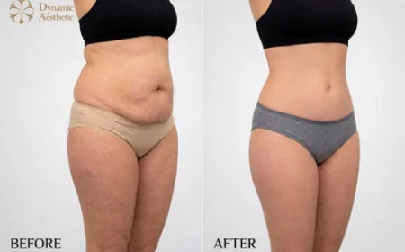 Tummy Tuck in Islamabad: Your Guide to a Confident New You