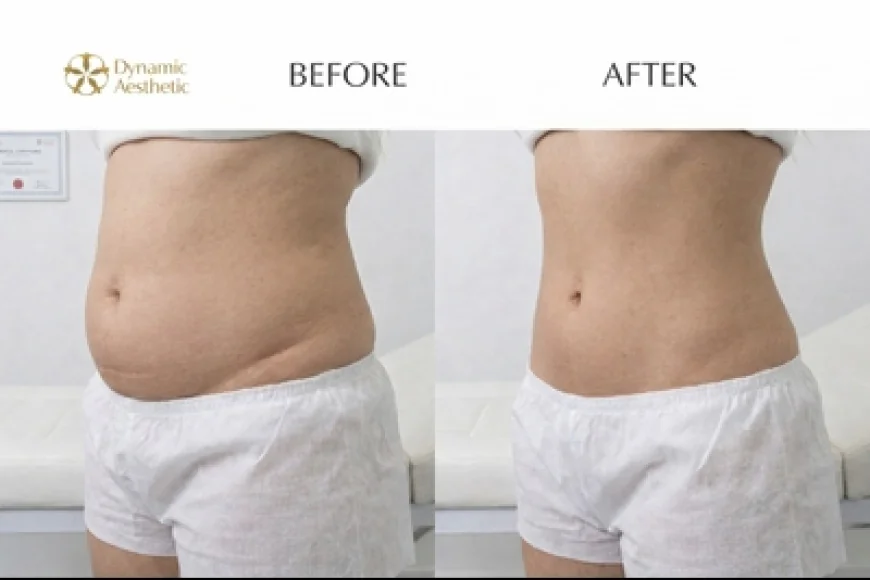 Liposuction in Islamabad: Before and After Transformations
