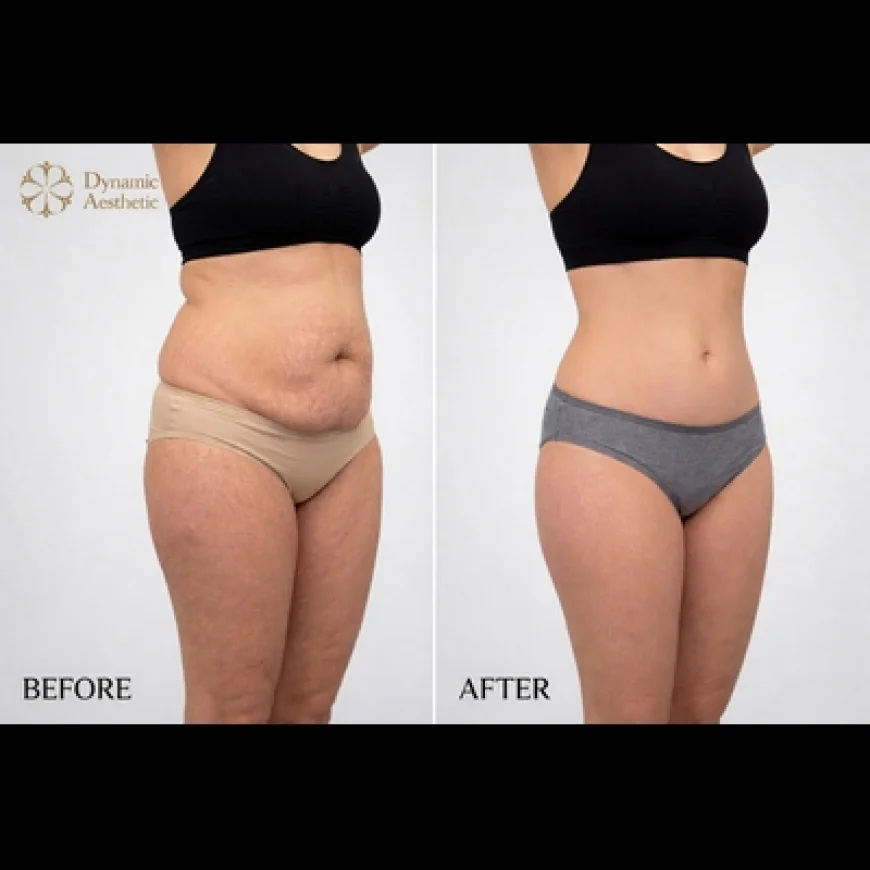 Tummy Tuck in Islamabad: Your Guide to a Confident New You