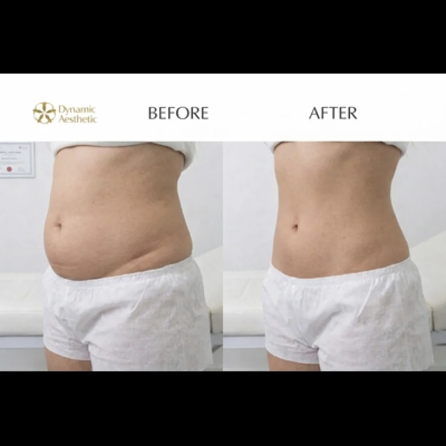 Liposuction in Islamabad: Before and After Transformations