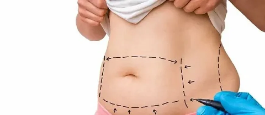 Liposuction Surgery in Islamabad: Pain, Procedure & Recovery Guide
