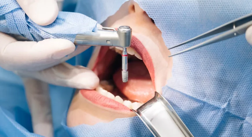 Is the Dental Implant Procedure Painful? What to Really Expect Step by Step