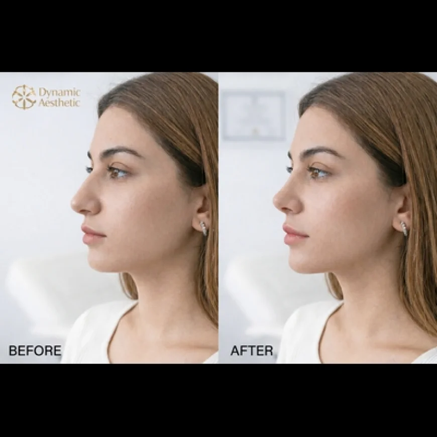 Advanced Rhinoplasty Techniques in Islamabad Clinics