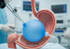 Understanding the Procedure of Allurion Balloon in Islamabad